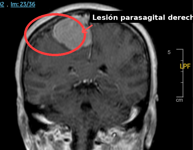 Resonancia magnética cerebral coronal con lesión frontal parasagital derecha señalada