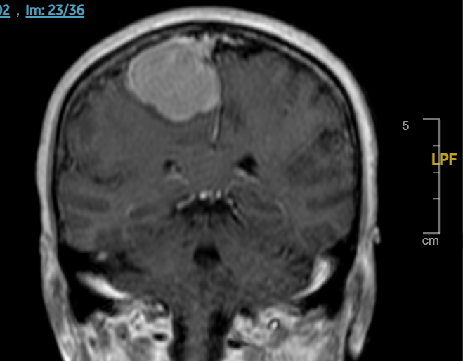 RM cerebral coronal con lesión frontal parasagital derecha