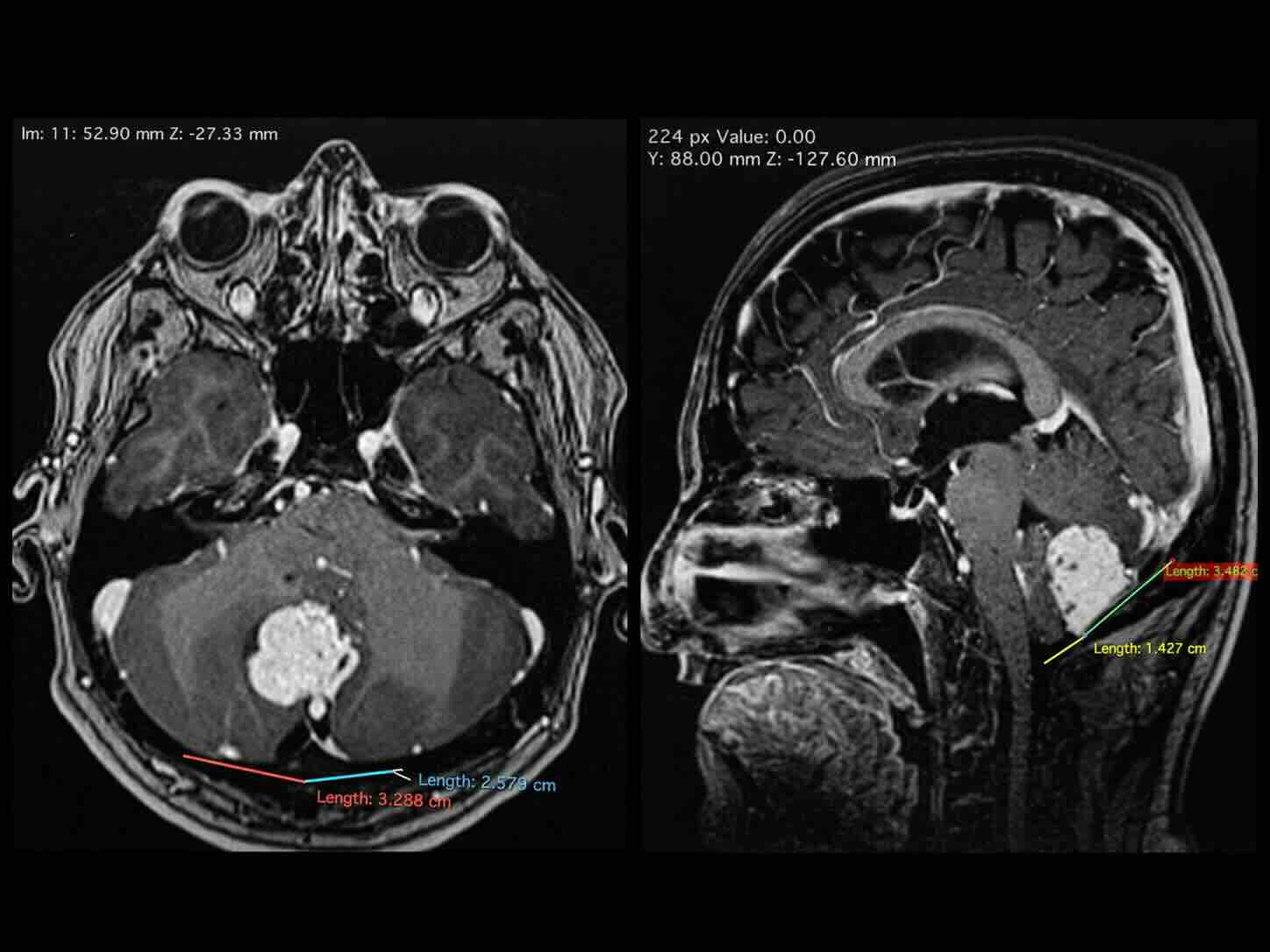 Meningioma de fosa posterior caudal sobre el foramen magno