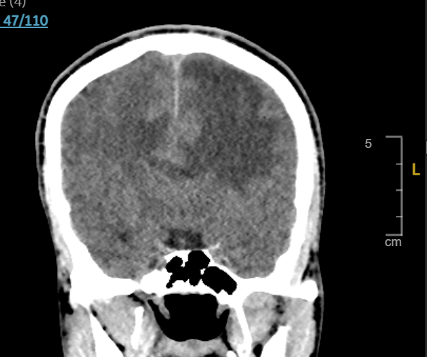 Primera crisis comicial como forma de presentación de una lesión frontal medial en un adulto joven