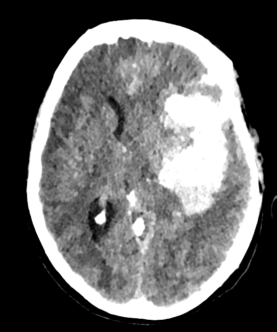 Caso docente: Hemorragia subaracnoidea aneurismática con hematoma intraparenquimatoso y deterioro por efecto de masa
