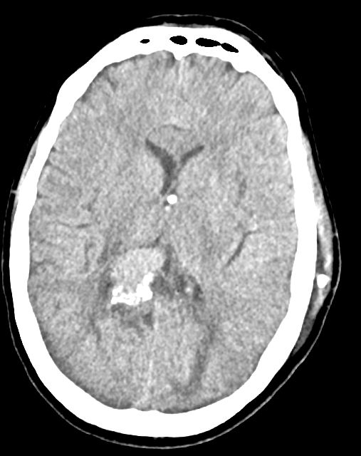 Caso docente: disfunción de derivación ventriculoperitoneal en paciente con hidrocefalia crónica y discapacidad neurológica grave