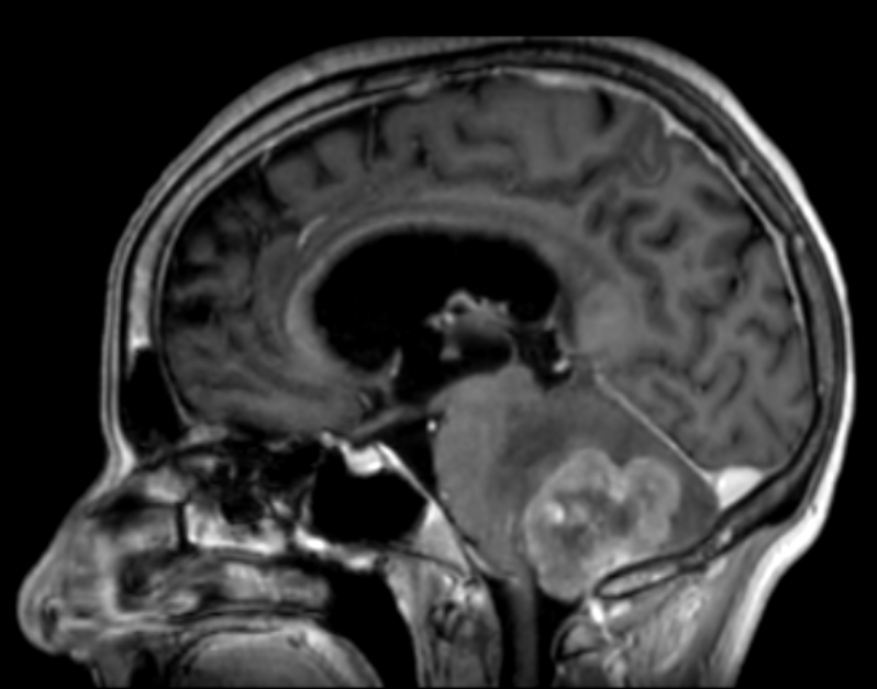 Hidrocefalia obstructiva por lesión de fosa posterior como presentación de probable neoplasia pulmonar