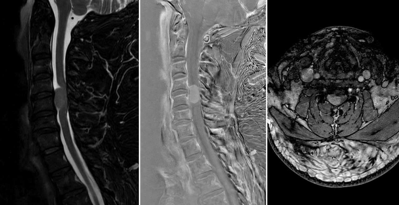 Meningioma cervical C4-C5 anterolateral derecho con mielopatía compresiva