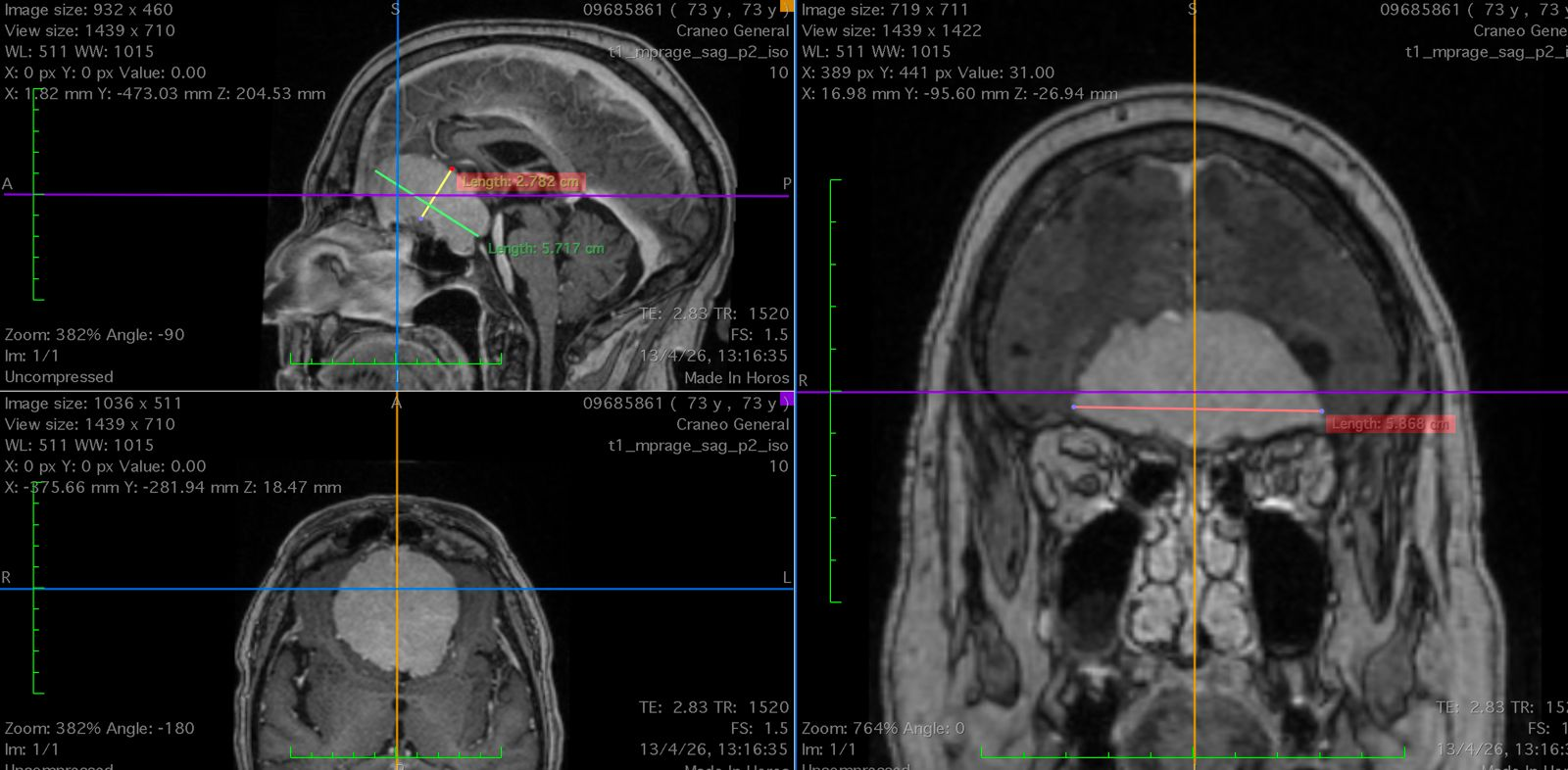 Meningioma gigante de surco olfatorio con extensión supraselar y compromiso neurovascular