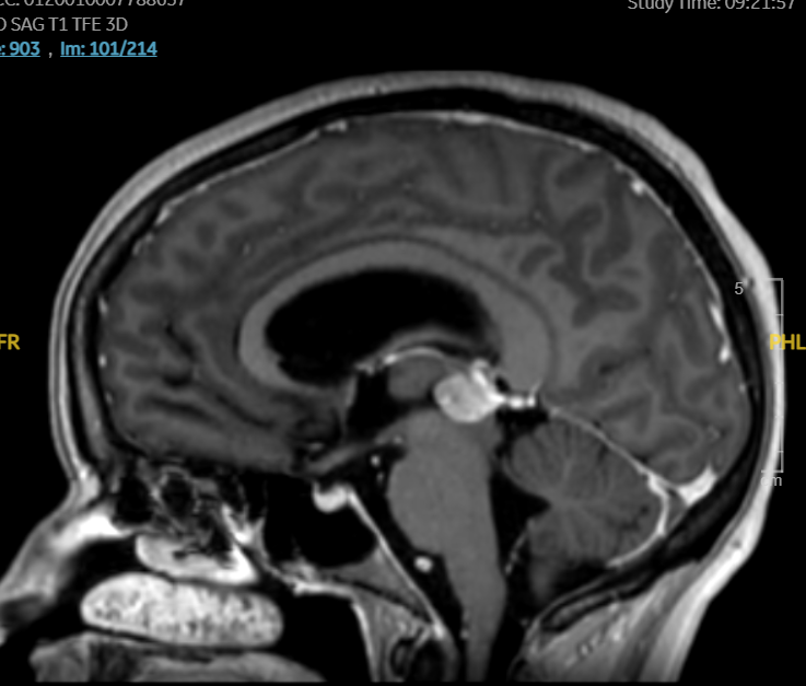 Hidrocefalia obstructiva secundaria a lesión pineal con fracaso precoz de ventriculostomía y deterioro neurológico agudo